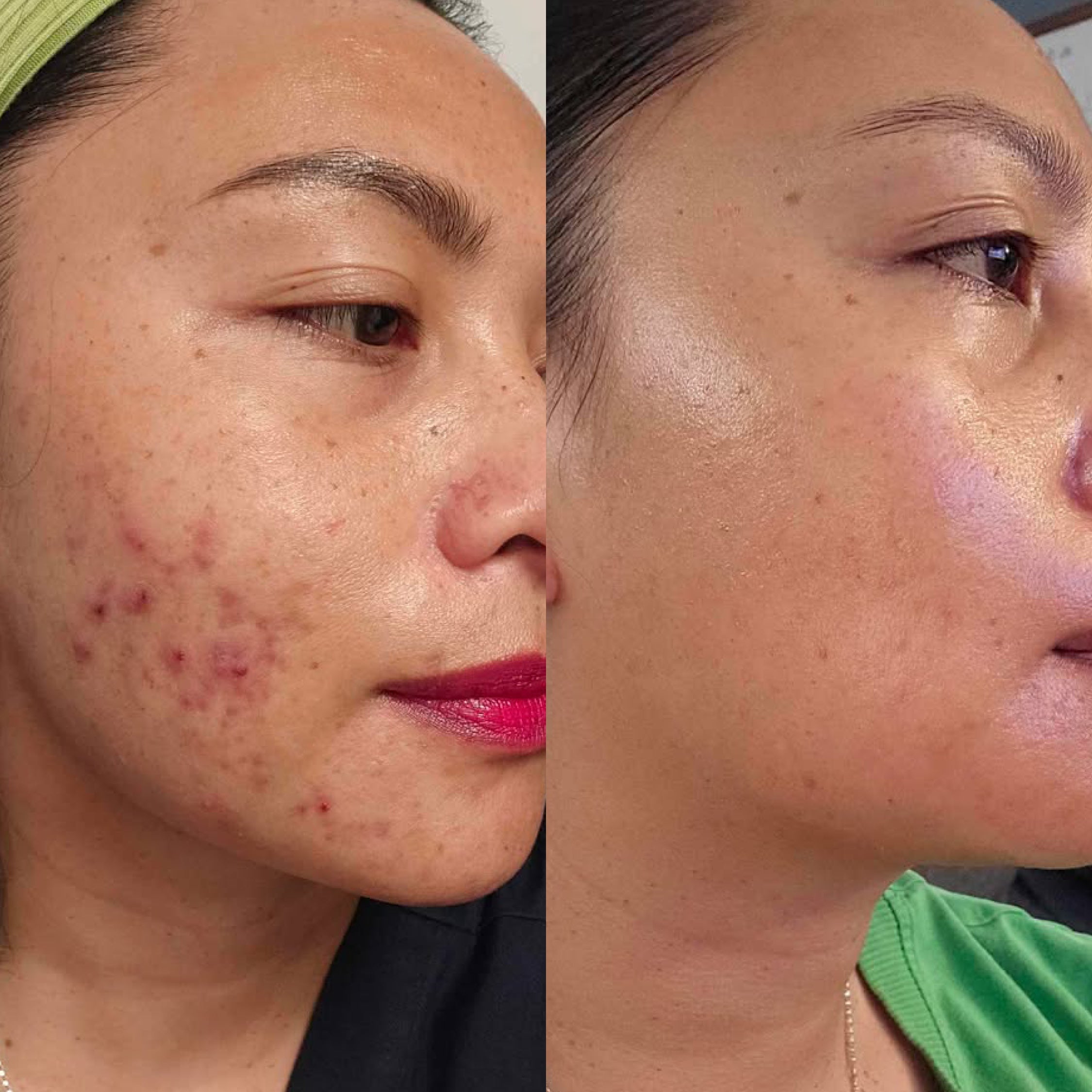 Comparison of a woman's face with acne before and after using Clear Skin System.
